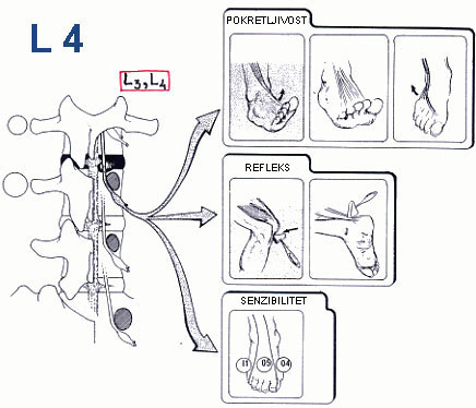 Prelom C2 vratnog pr�ljena